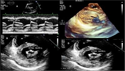 3D Echocardiography for Rheumatic Heart Disease Analysis: Ready for Prime Time